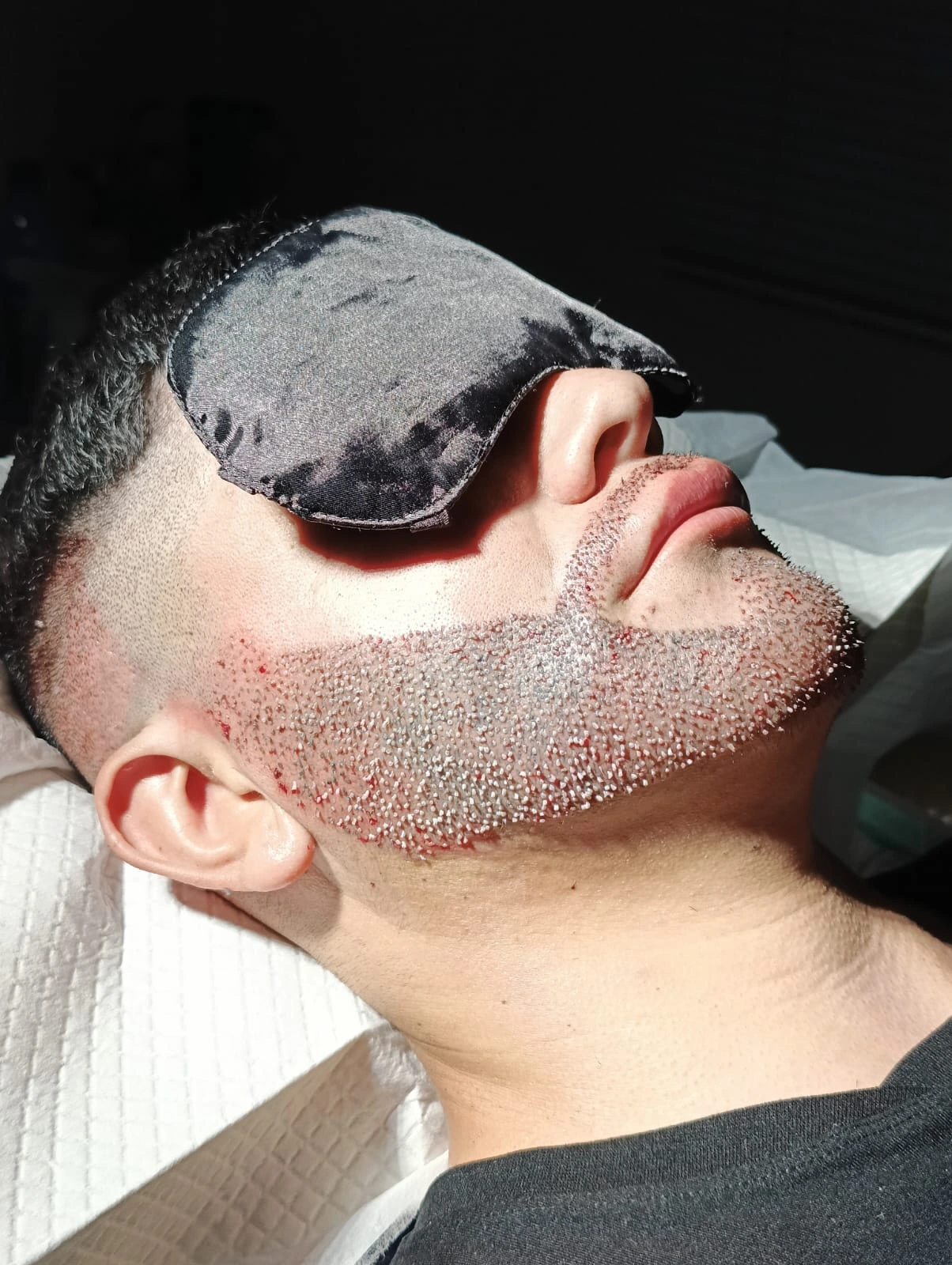 Transplante de Barba