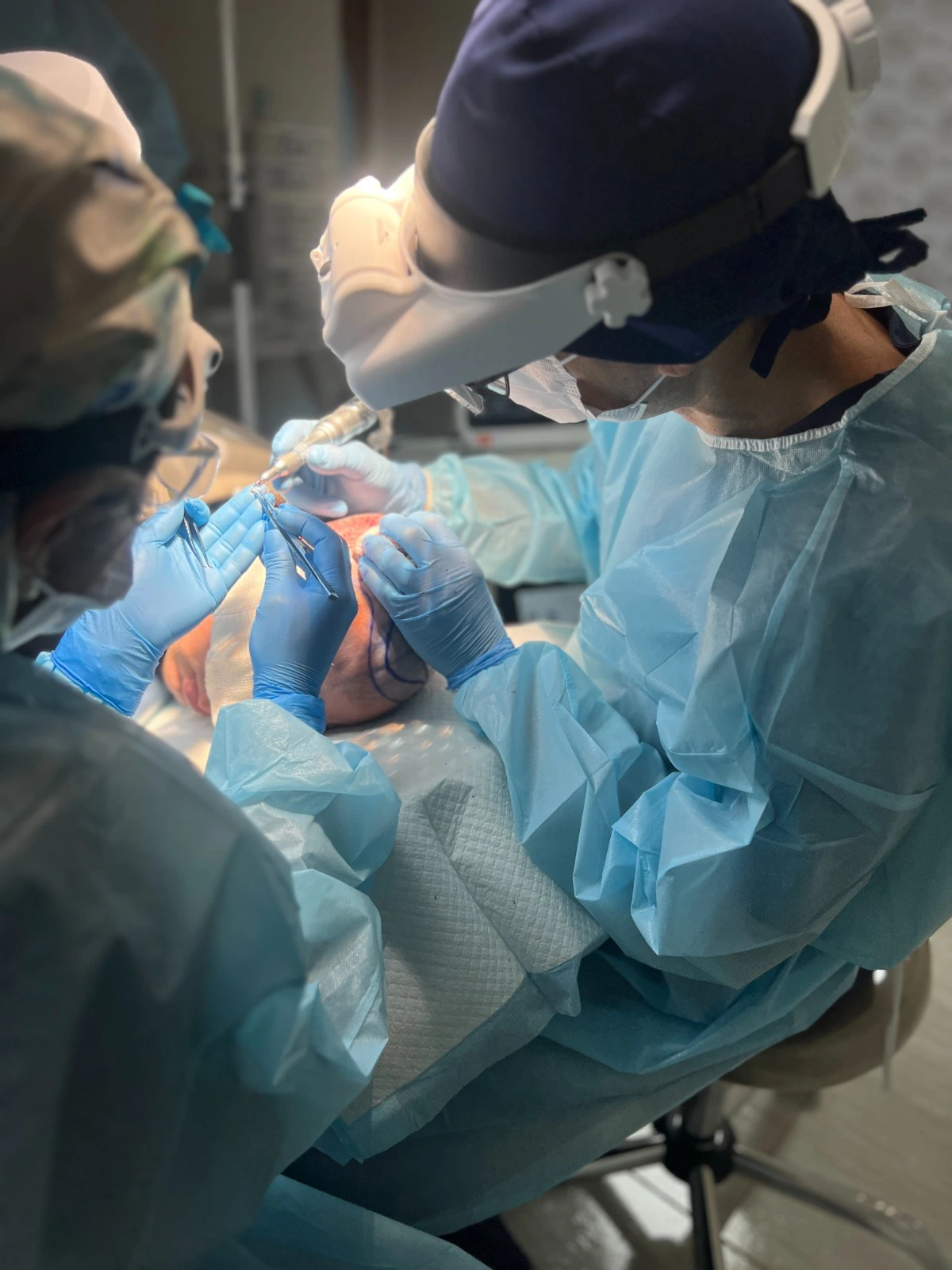 Transplante de Cabelo